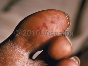 Clinical image of Subacute bacterial endocarditis - imageId=47822. Click to open in gallery.  caption: 'Angulated reddish and violaceous macules and thin papules on the great toe.'