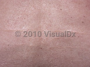 Clinical image of Linear focal elastosis - imageId=4790796. Click to open in gallery.  caption: 'A close-up of linear, yellow, striae-like plaques on the back.'