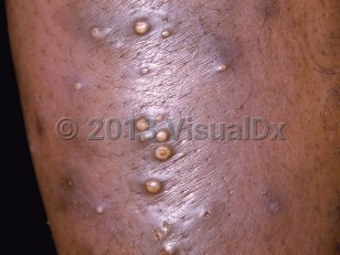 Clinical image of Furunculosis - imageId=47929. Click to open in gallery.  caption: 'A close-up of multiple pustules of varying sizes arising on a faintly violaceous plaque.'