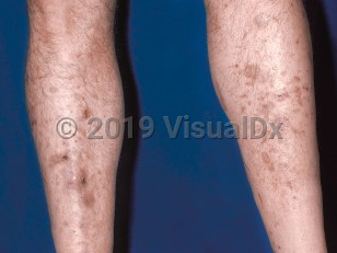 Clinical image of Diabetic dermopathy - imageId=47971. Click to open in gallery.  caption: 'Reddish-brown macules and patches, atrophic whitish plaques, and scattered crusts on the shins.'