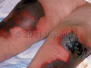 Clinical image of Warfarin necrosis - imageId=4799. Click to open in gallery.  caption: 'Large, figurate, vesiculated, and necrotic plaques with eschar formation in areas, and peripheral erythema, on the legs.'