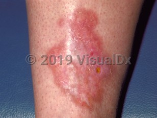 Clinical image of Necrobiosis lipoidica - imageId=48123. Click to open in gallery.  caption: 'An erythematous, shiny plaque with central scarring and erosion on the shin.'