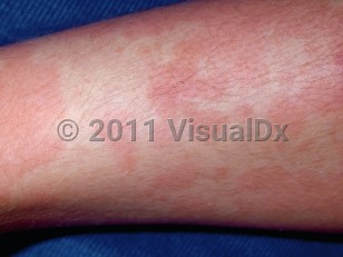 Clinical image of Serum sickness