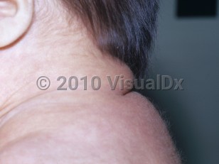 Clinical image of Congenital hypothyroidism - imageId=4853235. Click to open in gallery.  caption: 'A puffy appearance to the posterior neck and back.'