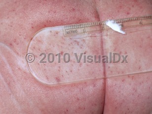 Clinical image of Newborn thrombocytopenic purpura - imageId=4854242. Click to open in gallery.  caption: 'Diffuse petechiae and purpura on the buttocks.'