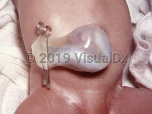 Clinical image of Omphalocele - imageId=4855876. Click to open in gallery.  caption: '<span>Omphalocele in Beckwith-Wiedemann syndrome.</span>'