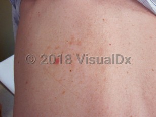 Clinical image of IgA pemphigus - imageId=4861184. Click to open in gallery.  caption: 'A reddish plaque on the back.'