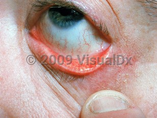 Clinical image of Blepharitis - imageId=486428. Click to open in gallery.  caption: 'Conjunctival infection on the inner eyelid and eye and surrounding scaling and erythema in a patient on medication.'