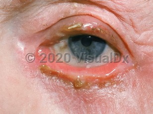 Clinical image of Ectropion - imageId=486876. Click to open in gallery.  caption: 'Eversion of the inferior lid and erosion and crusting of both lid margins.'