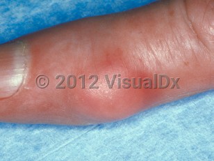 Clinical image of Gout