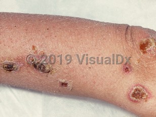 Clinical image of Mycobacterium avium-intracellulare infection
