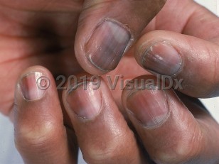 Clinical image of Drug-induced nail pigment - imageId=488604. Click to open in gallery.  caption: 'Longitudinal deep gray bands of varying thickness on the fingernails of an HIV-infected patient.'