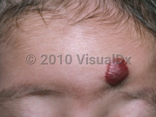 Clinical image of Infantile hemangioma
