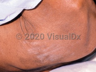 Clinical image of HIV/AIDS-related pruritus - imageId=491840. Click to open in gallery.  caption: 'Diffuse dry skin and scratch marks on the back of a patient with AIDS.'