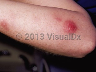 Clinical image of Atypical mycobacterial infection - imageId=49216. Click to open in gallery.  caption: 'A bright-pink scaly nodule and nearby fainter scaly pink plaques on the arm.'