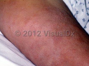 Clinical image of Leprosy - imageId=49440. Click to open in gallery.  caption: 'Numerous reddish-brown plaques and nodules on the arm.'