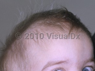 Clinical image of Hurler syndrome - imageId=4976944. Click to open in gallery.  caption: 'Misshapen head secondary to craniosynostosis.'
