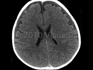 Imaging Studies image of Pediatric abusive head trauma - imageId=4989248. Click to open in gallery.  caption: '<span>Noncontrast head CT demonstrates bilateral chronic subdural hematomas. Note the difference in densities between CSF (in the ventricles) and the fluid in the subdural space. The subdural fluid is more dense and may consist of old blood or blood mixed with CSF.</span>'