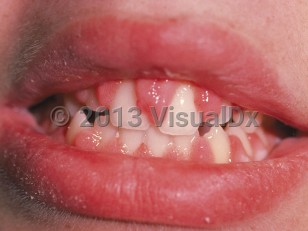 Clinical image of Gingival enlargement - imageId=5007. Click to open in gallery.  caption: 'Hypertrophy of gums with overlapping of the teeth.'