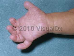 Clinical image of Down syndrome - imageId=5021842. Click to open in gallery.  caption: 'A single palmar crease.'