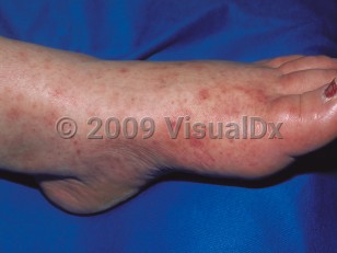 Clinical image of Chronic meningococcemia - imageId=50545. Click to open in gallery.  caption: 'Petechiae and purpuric papules arising within erythematous patches on the dorsal foot.'