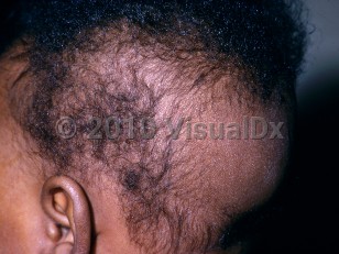 Clinical image of Occipital neonatal alopecia - imageId=5055638. Click to open in gallery.  caption: 'A hairless plaque with overlying fine scale on the occipital scalp.'