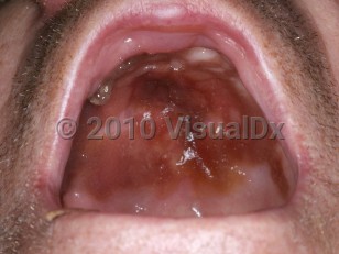 Clinical image of Extranodal NK/T-cell lymphoma, nasal type - imageId=5073152. Click to open in gallery.  caption: 'Ulceration and crusting on the palate.'