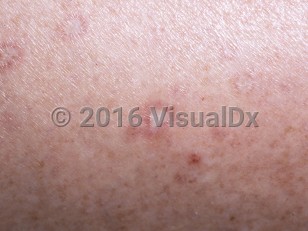 Clinical image of Malignant atrophic papulosis - imageId=5073217. Click to open in gallery.  caption: 'A close-up of porcelain-white, depressed papules with reddish rims.'