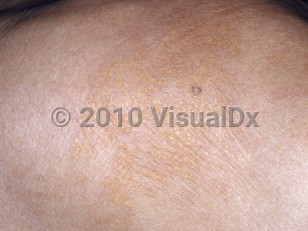 Clinical image of Plane xanthomas - imageId=5080420. Click to open in gallery.  caption: 'A close-up of confluent yellowish papules forming plaques.'