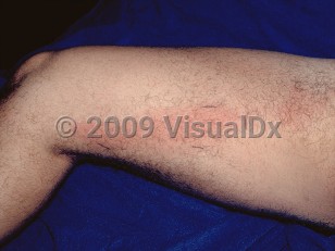 Clinical image of Cellulitis
