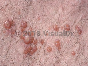 Clinical image of Molluscum contagiosum