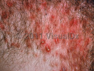 Clinical image of Acne conglobata