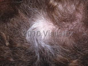 Clinical image of Disorders of hair color - imageId=5189648. Click to open in gallery.  caption: 'A circumscribed patch of white hair on the scalp.'