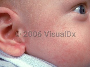 Clinical image of Hereditary acrodermatitis enteropathica - imageId=524030. Click to open in gallery.  caption: 'Patchy erythema on the cheek and ear.'