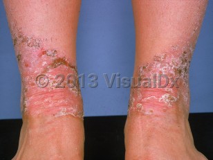 Clinical image of Acquired acrodermatitis enteropathica - imageId=524508. Click to open in gallery.  caption: 'Fairly well-demarcated eroded, crusted, and scaly plaques on the lower legs.'
