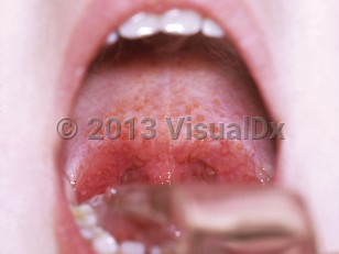 Clinical image of Streptococcal pharyngitis - imageId=5246650. Click to open in gallery.  caption: 'A "cobblestone throat" caused by patchy lymphoid tissue hypertrophy and exudates and erythema of the uvula and tonsillar fauces.'