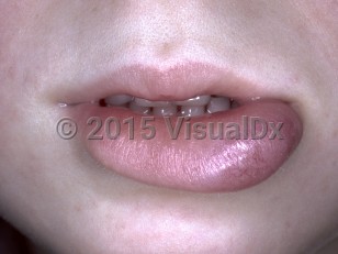 Clinical image of Rhabdomyosarcoma - imageId=5246671. Click to open in gallery.  caption: 'A violaceous mass with overlying telangiectasia on the lower lip.'