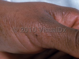 Clinical image of Acrokeratoelastoidosis - imageId=525091. Click to open in gallery.  caption: 'Numerous flat, brown, keratotic papules on the medial thenar eminence and thumb.'