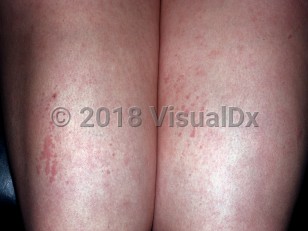 Clinical image of Adult onset Still disease - imageId=5257434. Click to open in gallery.  caption: 'Linear arrays of urticarial papules on the legs.'