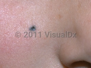 Clinical image of Traumatic tattoo - imageId=5269946. Click to open in gallery.  caption: 'A bluish-black papule on the cheek.'