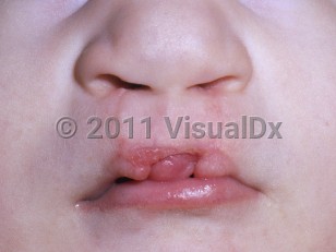 Clinical image of Trisomy 13 syndrome - imageId=5272050. Click to open in gallery.  caption: 'Cleft lip.'