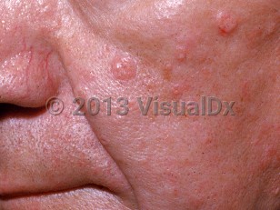 Clinical image of Sebaceous adenoma - imageId=527472. Click to open in gallery.  caption: 'Two large, pink and yellow papules (adenomas) and scattered, smaller, pink and yellow umbilicated papules (sebaceous hyperplasia) on the cheek.'