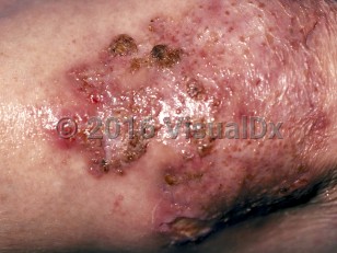 Clinical image of Ecthyma - imageId=52771. Click to open in gallery.  caption: 'A close-up of a large eroded, ulcerated, and crusted plaque.'