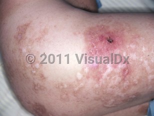 Clinical image of Leprosy-Lucio phenomena - imageId=5291837. Click to open in gallery.  caption: 'An erythematous plaque with an overlying eschar and surrounding depigmented plaques with light brown haloes on the lateral thigh and buttock.'