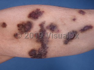 Clinical image of AIDS-associated Kaposi sarcoma - imageId=530174. Click to open in gallery.  caption: 'Deeply violaceous, smooth papules and plaques on the leg. Note that some having a surrounding faint yellowish color reminiscent of bruises.'