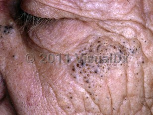 Clinical image of Favre-Racouchot syndrome - imageId=5307612. Click to open in gallery.  caption: 'Numerous open comedones of varying sizes and a few yellowish papules (small cysts) arising in sun-damaged skin on the cheek and nasal bridge.'