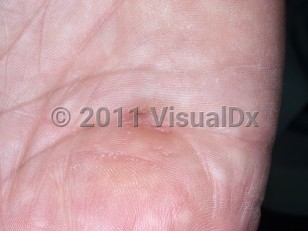 Clinical image of Dupuytren disease - imageId=5311536. Click to open in gallery.  caption: 'A horizontal depression flanked by fibrotic bands on the palm.'