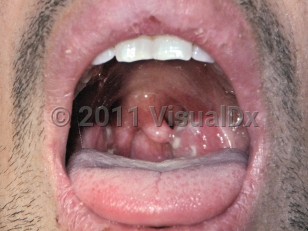 Clinical image of Tonsillitis - imageId=5314053. Click to open in gallery.  caption: '<span>Exudative tonsillitis.  24 year old male presented with severe sore throat, fever with chills, body aches,  and malaise. On examination, there was pus on the tonsillar area with  swollen uvula and bilateral, tender, palpable jugulodigastric lymph nodes. </span>'