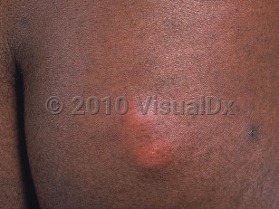 Clinical image of Arthropod bite or sting - imageId=531756. Click to open in gallery.  caption: 'A close-up of two markedly edematous pink nodules on the buttock of an immunocompromised patient.'