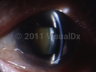 Clinical image of Acute angle-closure glaucoma